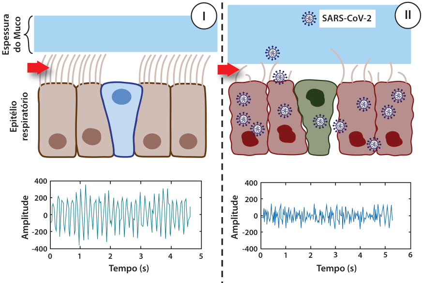 Esquema comparativo do epitélio respiratório em condições normais (I) e infectado por SARS-CoV-2 (II). No painel I, a seta vermelha aponta para os cílios na superfície apical das células sob a camada de muco; abaixo, o gráfico de Amplitude em função do Tempo (s) mostra oscilações regulares com amplitude de cerca de -200 a 200. No painel II, com partículas de SARS-CoV-2 infectando as células, os cílios estão encurtados ou ausentes (seta vermelha); abaixo, o gráfico de Amplitude por Tempo (s) mostra oscilações com amplitude significativamente reduzida.