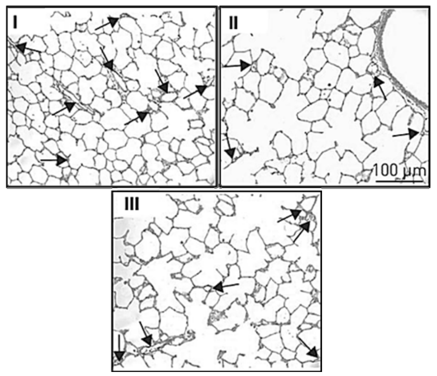 Três painéis de fotomicrografias identificados por I, II e III, mostrando o tecido alveolar pulmonar em corte transversal na escala de 100 micrometros. No painel I, os espaços alveolares são menores e mais numerosos, delimitados por paredes finas com muitas setas indicando capilares alveolares. Nos painéis II e III, os espaços alveolares são progressivamente maiores e confluentes, com paredes rompidas ou reduzidas e menor quantidade de setas apontando capilares.