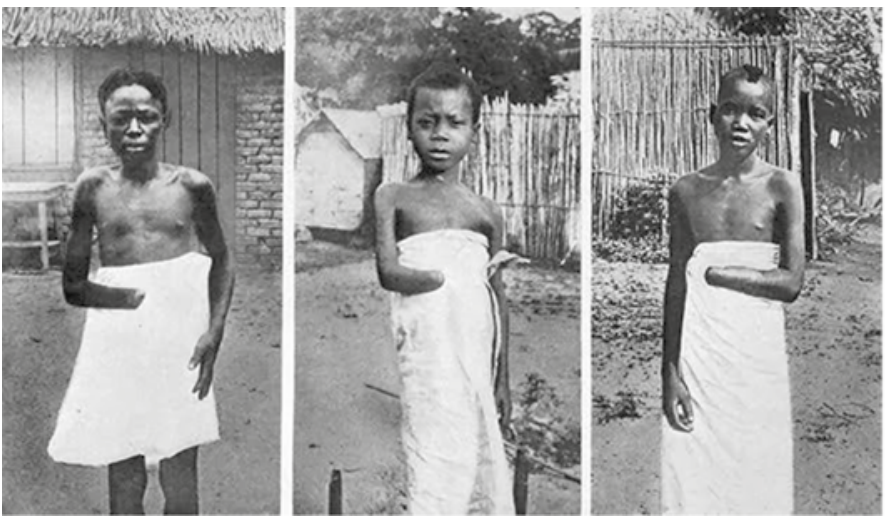 F1 Três fotografias em preto e branco dispostas lado a lado, mostrando jovens congoleses mutilados, cada um com uma das mãos decepadas, trajando panos brancos amarrados ao corpo.
