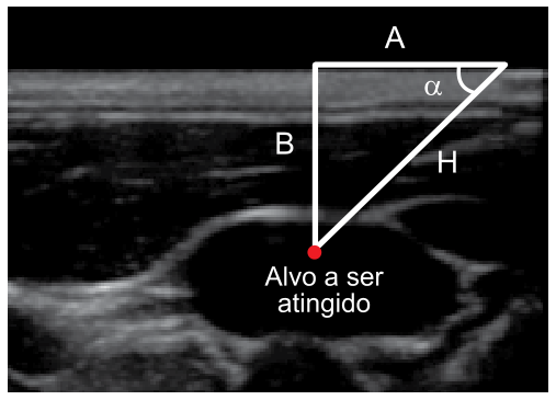 Imagem de ultrassom indicando a anatomia da veia jugular interna com um triângulo retângulo sobreposto, onde o cateto horizontal adjacente é A, o cateto vertical oposto é B, a hipotenusa é H, o ângulo entre H e A é alfa, e o vértice inferior aponta para o alvo a ser atingido.