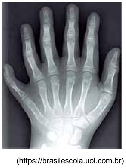 Radiografia da mão de uma pessoa apresentando seis dedos completamente formados (polidactilia).