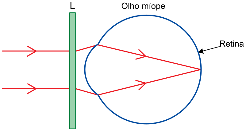 Esquema representando uma lente L retangular diante de um olho míope circular. Dois raios de luz vermelhos paralelos incidem horizontalmente da esquerda, sofrem refração divergente ao atravessar a lente L e, ao penetrarem no globo ocular, convergem até se encontrarem em um ponto sobre a retina.