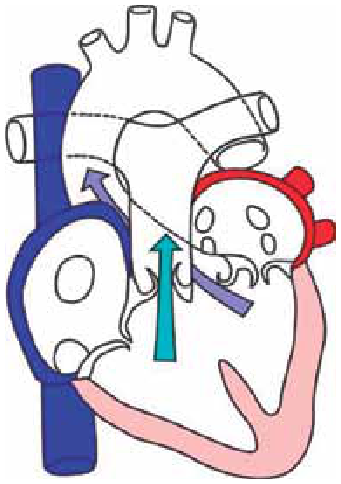 Esquema anatômico do coração de um vertebrado em corte frontal, evidenciando dois átrios e um ventrículo único. O átrio direito está destacado em azul e o átrio esquerdo em vermelho; na parte inferior, o ventrículo comunica-se com ambos e apresenta setas indicando a ejeção do sangue em direção ao tronco arterial.
