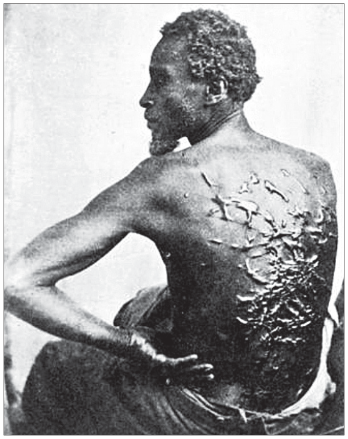 F1 Fotografia histórica de 1863 mostrando um homem negro escravizado fugitivo, visto de perfil e de costas nuas, exibindo extensas e profundas cicatrizes queloidianas decorrentes de chicotadas.