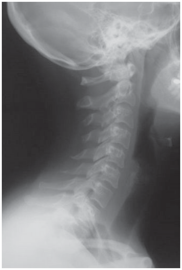 Radiografia em vista lateral da região do pescoço, evidenciando as vértebras da coluna cervical em tons claros, enquanto os tecidos moles e o ar ao redor aparecem em tons mais escuros.