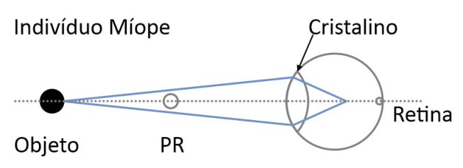 Esquema intitulado “Indivíduo Míope”. Sobre um eixo horizontal pontilhado, o Objeto está à esquerda do ponto remoto PR e do olho. Dois raios partem do objeto, divergem até o Cristalino e, após atravessá-lo, convergem em um ponto à frente da Retina, indicada na parte posterior do olho.