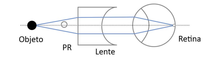 Esquema com os rótulos Objeto, PR, Lente e Retina. O objeto está à esquerda do PR, seguido de uma lente plano-côncava e do olho, sobre um eixo horizontal pontilhado. Dois raios divergem do objeto até a face plana da lente, seguem paralelos entre si até o cristalino e então convergem na retina.