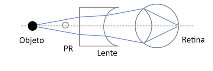 Esquema com os rótulos Objeto, PR, Lente e Retina. O objeto está à esquerda do PR, seguido de uma lente plano-côncava e do olho, sobre um eixo horizontal pontilhado. Dois raios divergem do objeto; na face plana da lente, passam a divergir menos e, na face côncava, passam a divergir mais até o cristalino, após o qual convergem na retina.