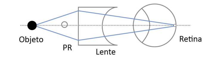 Esquema com os rótulos Objeto, PR, Lente e Retina. O objeto está à esquerda do PR, seguido de uma lente plano-côncava e do olho, sobre um eixo horizontal pontilhado. Dois raios divergem do objeto até a face plana da lente e, a partir dessa face, convergem em trajetórias retas até a retina, sem desvios na face côncava ou no cristalino.