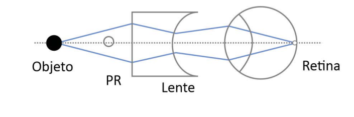 Esquema com os rótulos Objeto, PR, Lente e Retina. O objeto está à esquerda do PR, seguido de uma lente plano-côncava e do olho, sobre um eixo horizontal pontilhado. Dois raios divergem do objeto até a face plana da lente, convergem dentro da lente, voltam a divergir após a face côncava e, após atravessar o cristalino, convergem na retina.