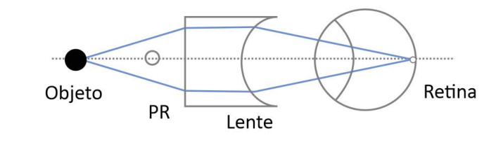 Esquema com os rótulos Objeto, PR, Lente e Retina. O objeto está à esquerda do PR, seguido de uma lente plano-côncava e do olho, sobre um eixo horizontal pontilhado. Dois raios divergem do objeto até a face plana da lente, seguem paralelos entre si dentro dela e, após a face côncava, convergem em trajetórias retas até a retina, sem desvio no cristalino.